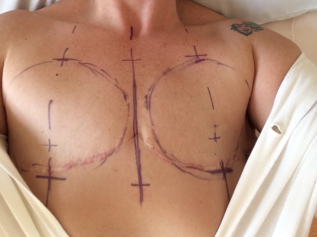Bröstrekonstruktion efter mastektomi